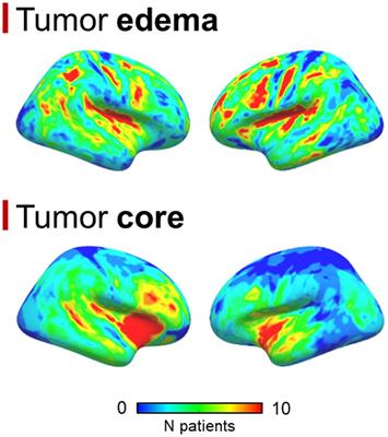 Patterns of gray and white matter functional networks involvement in glioblastoma patients: indirect mapping from clinical MRI scans